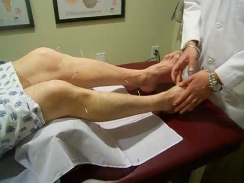 Acupuncture and Acupressure Treatment for knee pain.